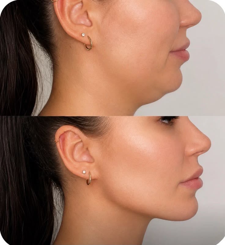 Preenchimentos Faciais
