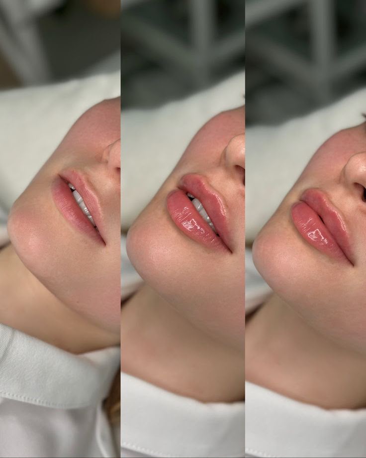 Preenchimento Labial